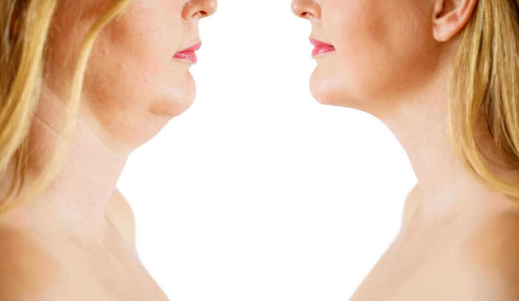 Double Chin treatment Durham before and after results