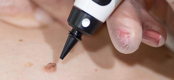 After Skin Tag Removal Durham
