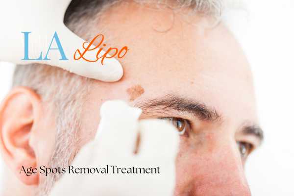 What Are the Most Effective Treatments for Age Spots Durham?