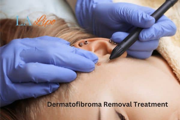 Dermatofibroma Removal Treatment Durham