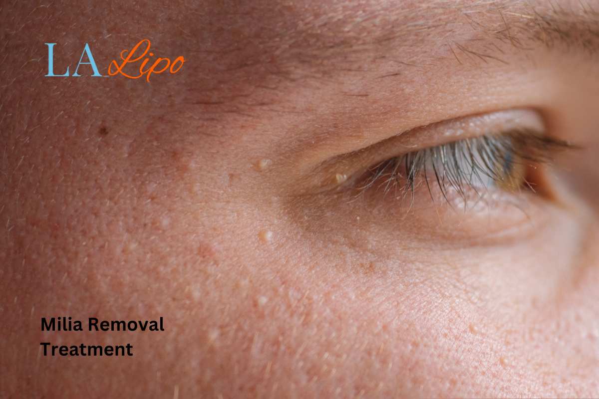 Cryopen Milia Removal: Is It the Easiest and Safest Option Durham?
