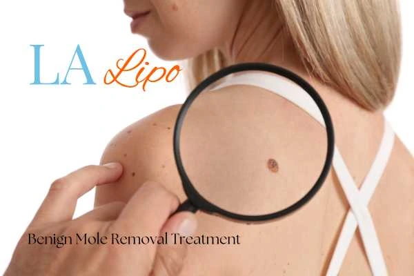 Woman having her inspection of blemish before mole removal Durham