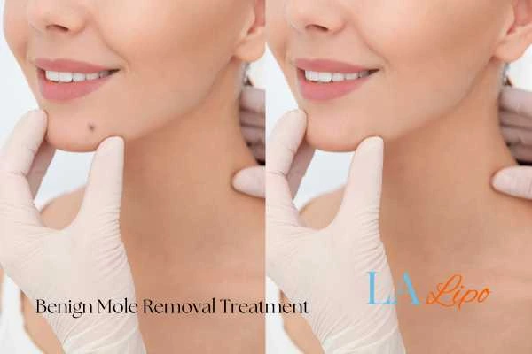 woman's before and after mole removal Durham results