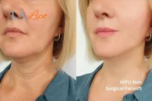 hi-fu for wrinkles Durham before and after results