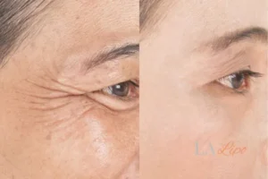 Before and after results of woman - HI-fu wrinkles reduction treatment Durham