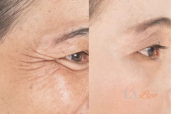 Before and after results of woman - HI-fu wrinkles reduction treatment Durham