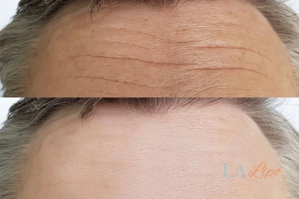 results of HIFU Durham on mans forehead to help reduce lines and wrinkles