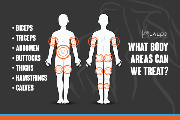 Graphic to show areas you can have LA-EMS Body Sculpting Durham treatment.