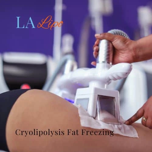 fat freezing - Cryolipolysis Durham