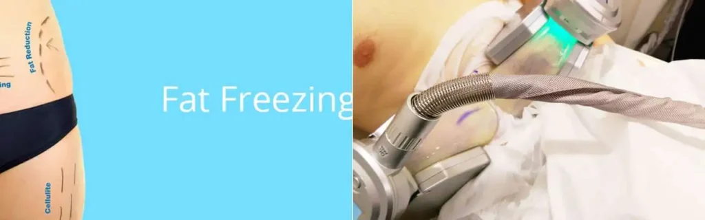 Fat freezing Durham on multiple areas of the body