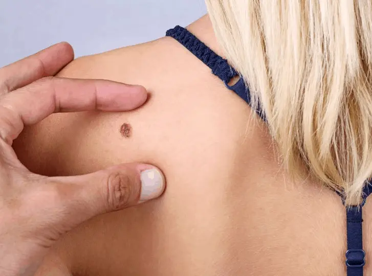 woman having mole removal Durham consultation before treatment.