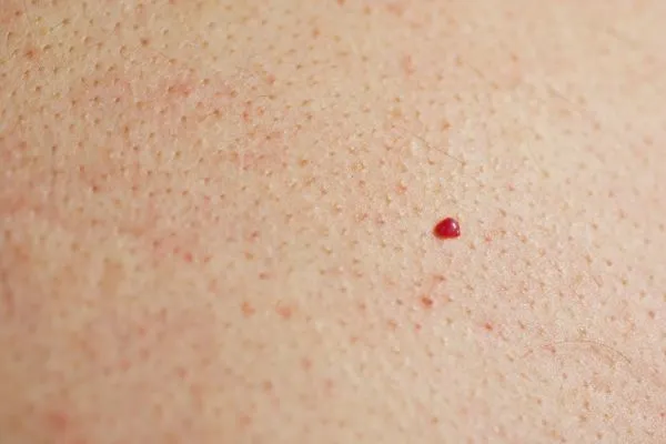 close up of a cherry angioma Durham