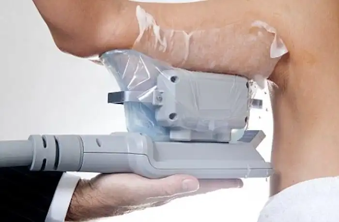 Picture of fat freezing Durham on the upper arms.