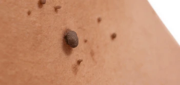 image of a skin tag Durham