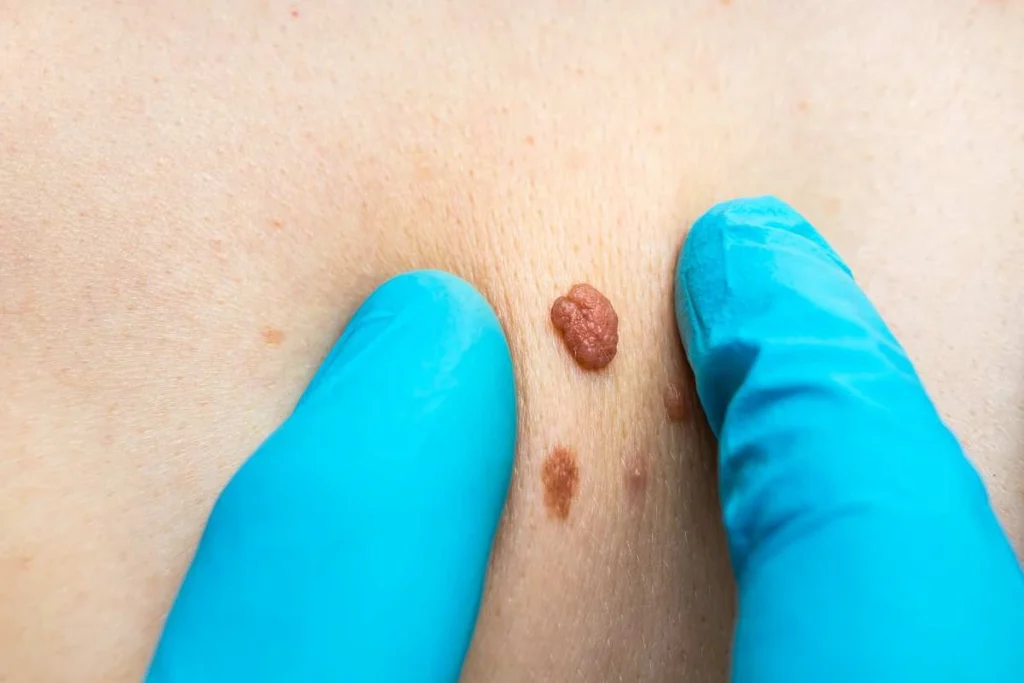 Consultant examining a skin tag Durham