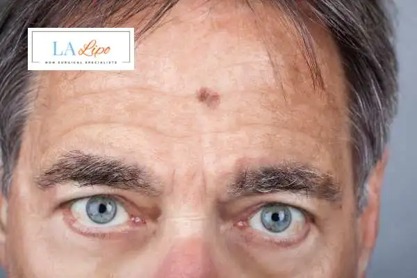 Solar Lentigo Removal Durham image of man with mark on his forehead