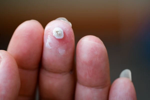 wart on person finger - cryotherapy to treat from LA LIPO Durham