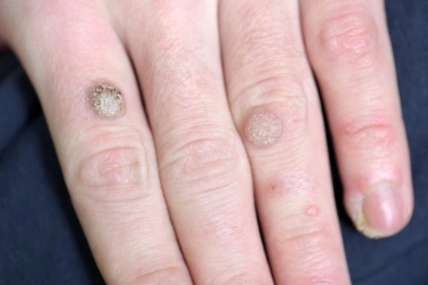 photo of warts on person hand - see wart removal Durham from LA LIPO