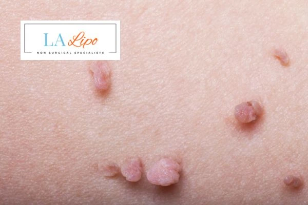 Does cryopen skin tag removal Durham hurt? Find out now call our team today!