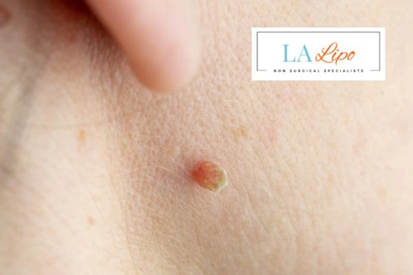 Book skin tag removal Durham today speak to our team now!