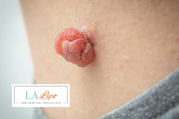 Interested in skin tag removal Durham? Concerned about the pain? Find out more today!