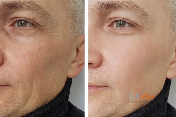 See the amazing results of Morpheus8 Treatment Durham!