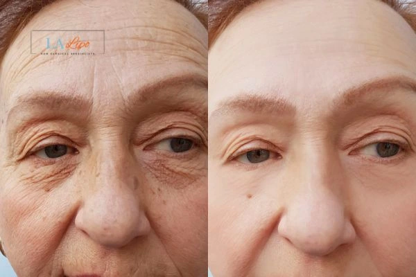 The powerful benefits of Morpheus8 Treatment Durham - Call Our team today!