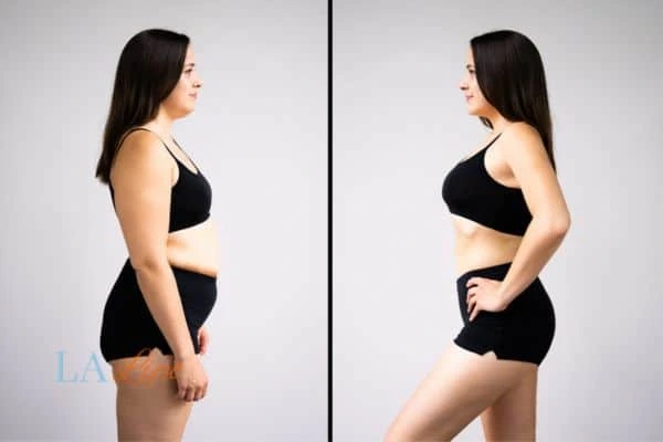 Picture of womans before and after using LA-EMS body sculpting to improve her core strength Durham