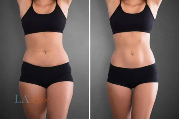 before and after results of non-surgical treatment to help a woman's body image and mental health Durham