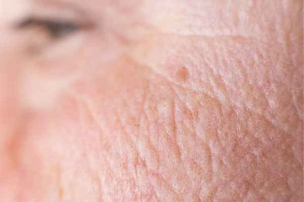 close up picture of a woman's face showing an age spot Durham