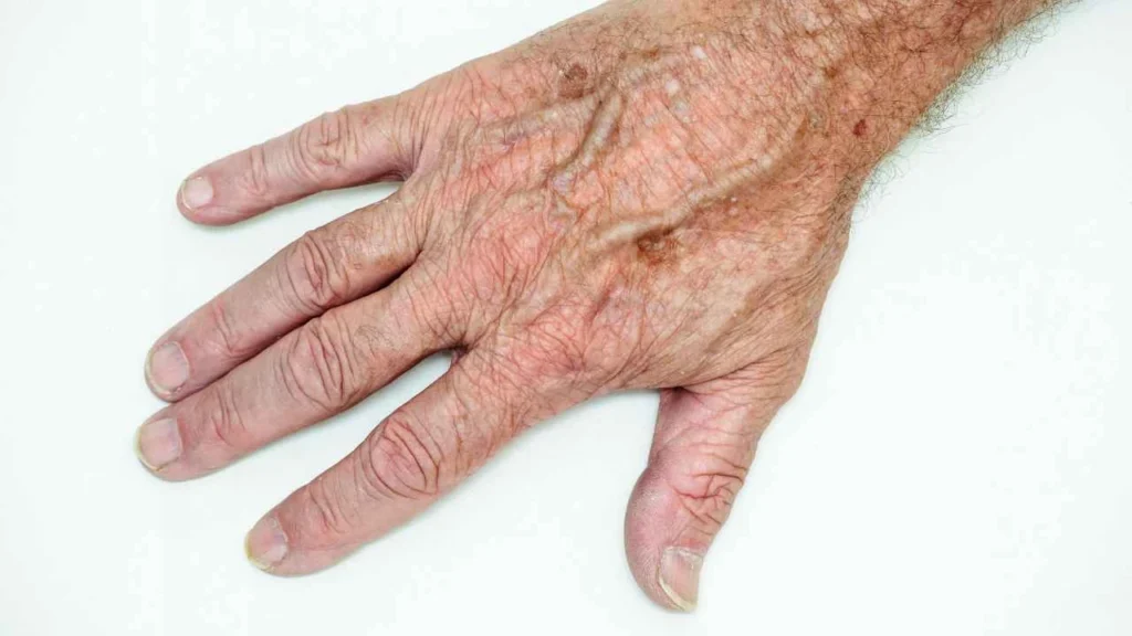 Male hand showing age spot Durham
