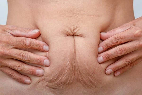 Image of a woman's stomach with loose skin - example of skin tightening Durham options