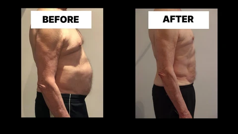 What Symptoms Can Diastasis Recti Cause in Men? Weak Core, Back Pain and Poor Posture Durham